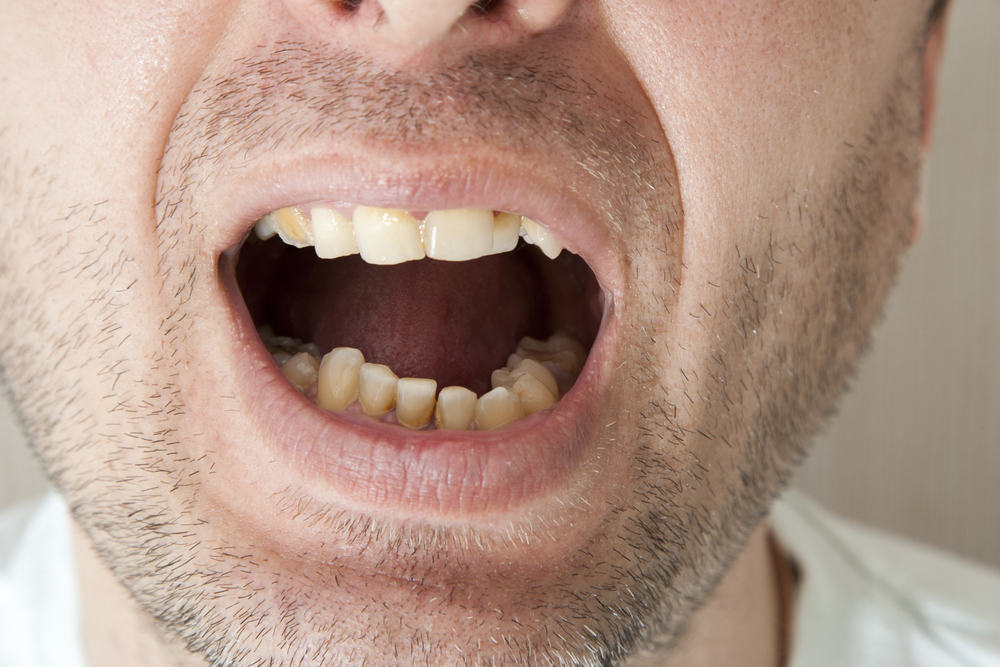 Cara Menghilangkan Plak Gigi Akibat Rokok